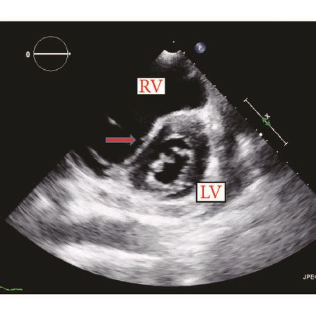 d-shaped left ventricle